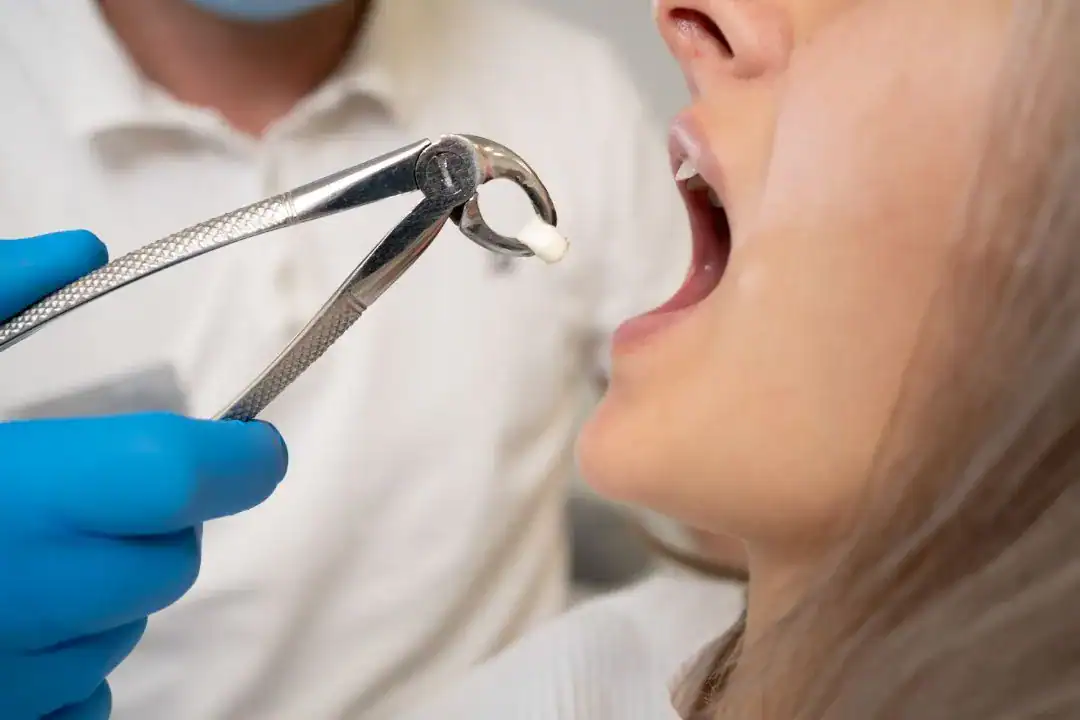 Tooth Extraction Penrith