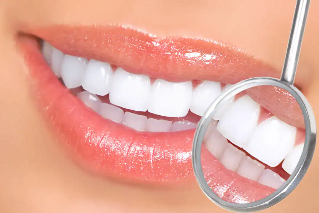 Teeth Whitening Penrith