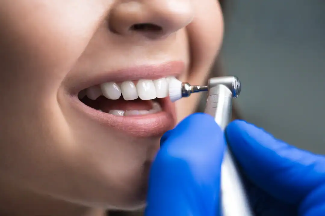 Teeth Cleaning Penrith